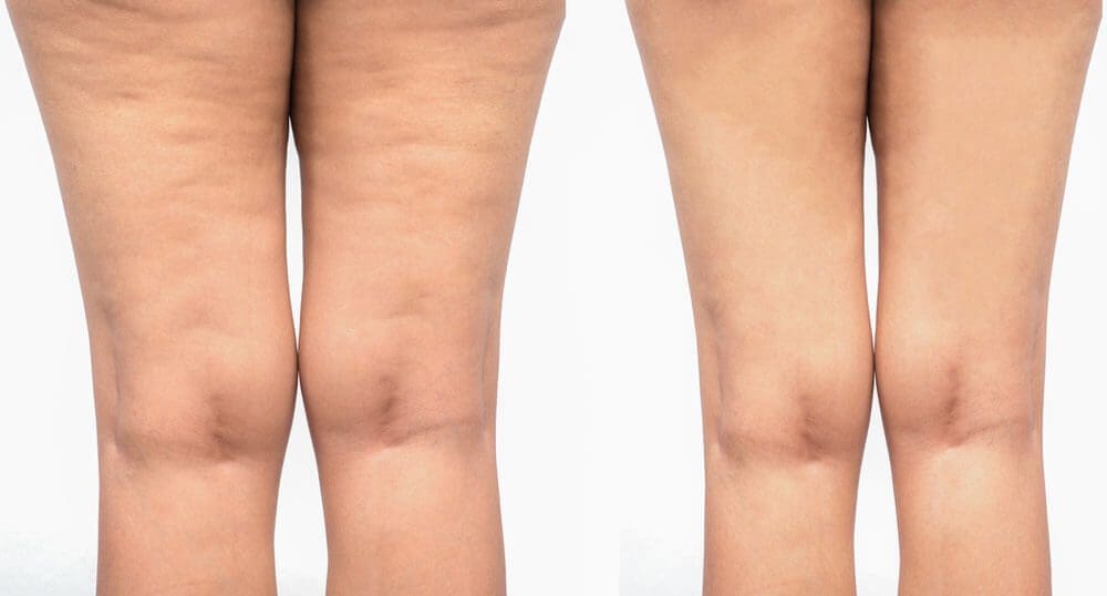 How to Get Rid of Cellulite